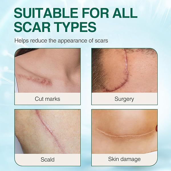 SILICONE SCAR GEL, ADVANCED SCAR TREATMENT CREAM GEL, KELOID BUMP REMOVAL FOR OLD AND NEW SCARS, SURGICAL SCARS, C-SECTION, BURN, STRETCH MARK 1.7 OZ (50G)