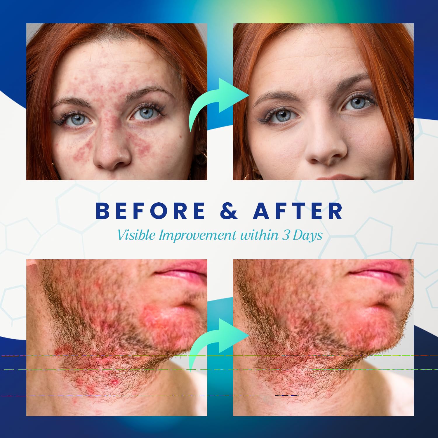 Seborrheic Dermatitis Psoriasis Cream: Antifungal Treatment - Traditional Herbal Infused - Relief for Flaking Irritated Scalp Skin - Steroids Free Lasting Result 3.4 Oz