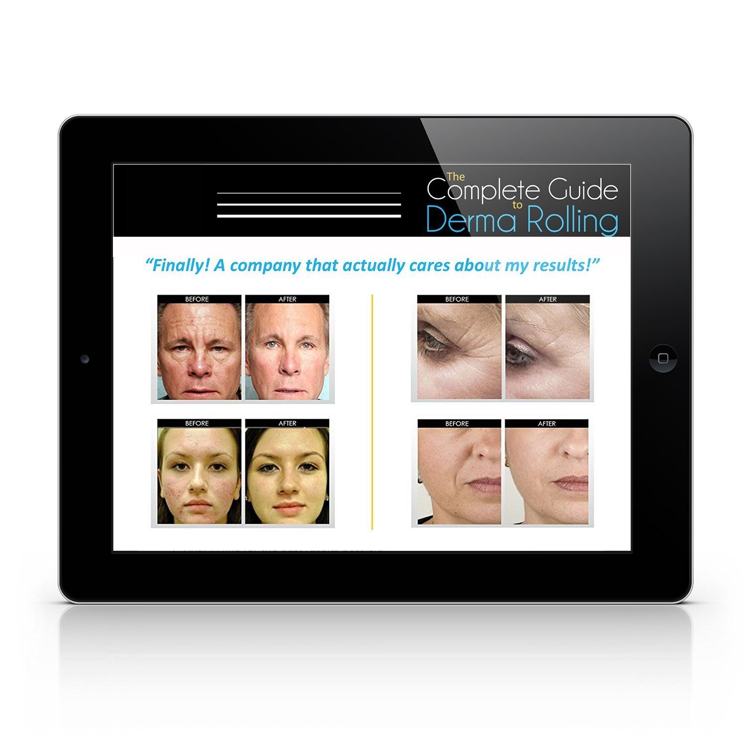 Uskincare Titanio Micro-ago Derma Roller 0.5mm+Istruzioni per l\'utente libero-Migliore Anti Invecchiamento Strumento-Il Trattamento di Rughe,Acne Cicatrici e Smagliature