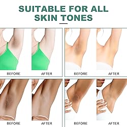 Vcetree Skin Bleaching Cream Skin Lightening for