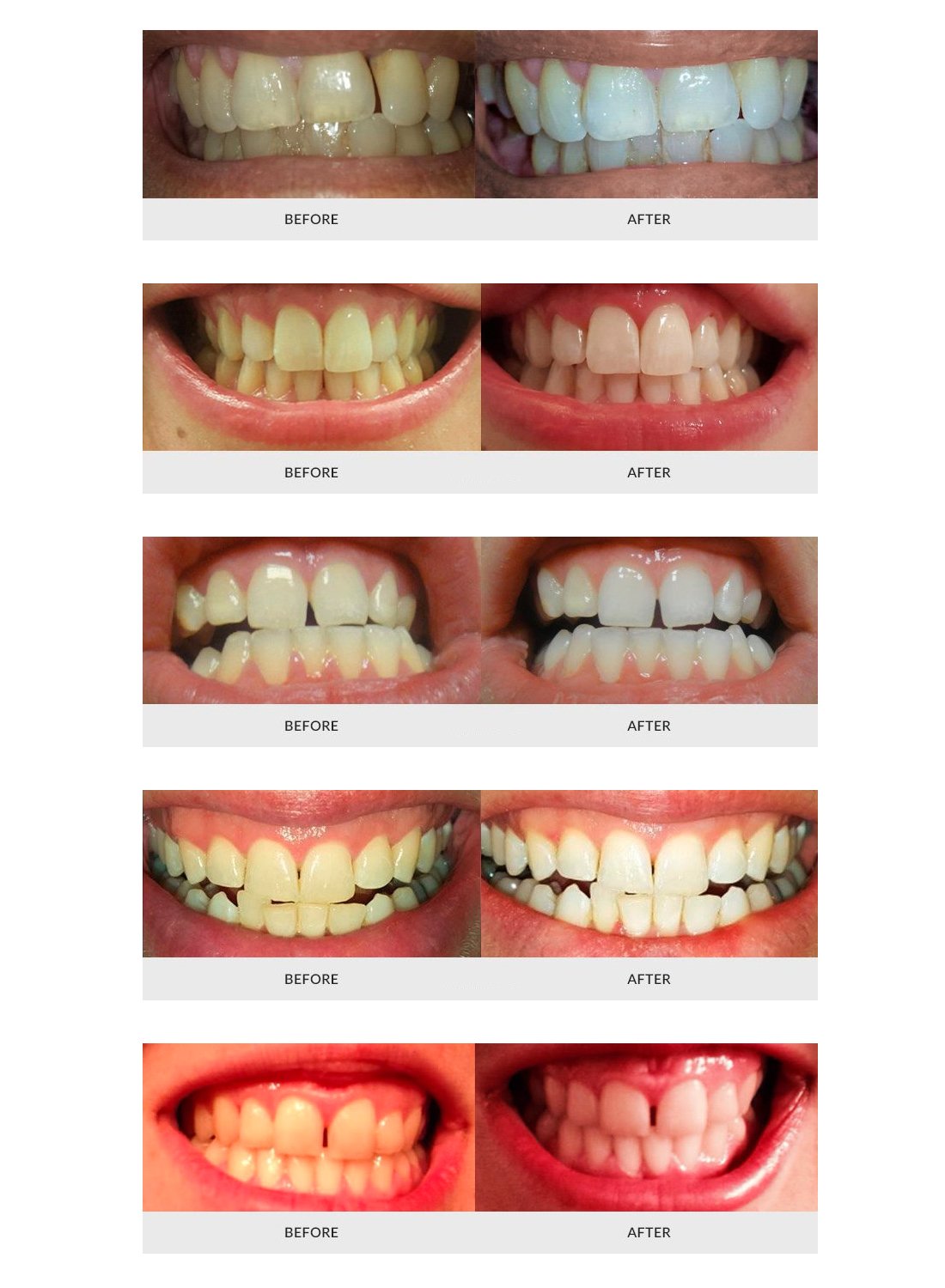 AuraGlow Teeth Whitening Kit, LED Light, 35% Carbamide Peroxide, (2) 5ml Gel Syringes, Tray and Case