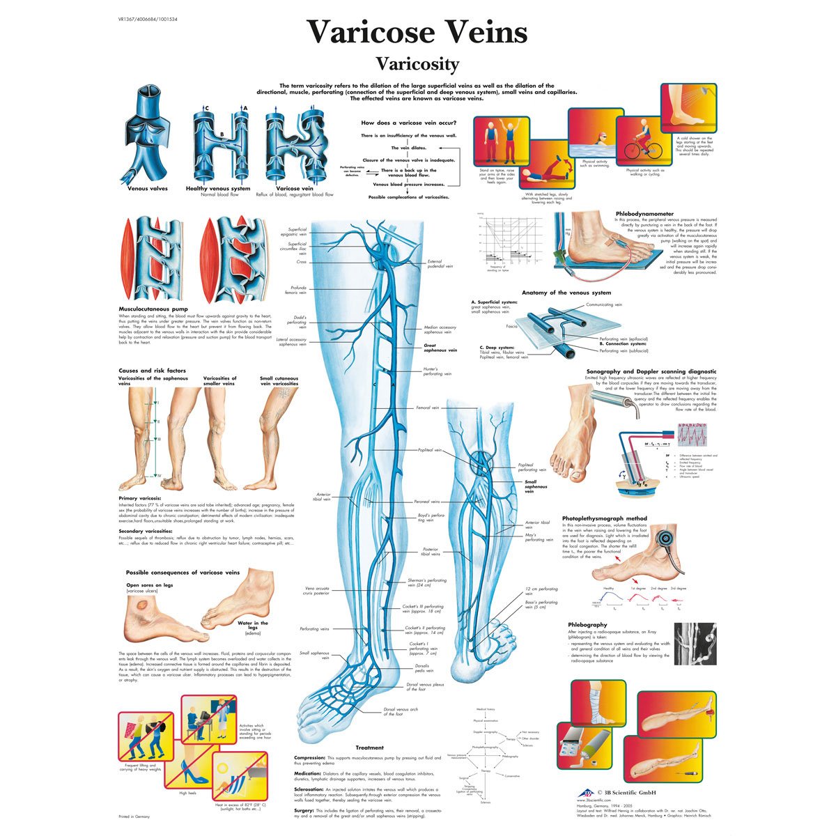 3B Scientific Human Anatomy - Varicose Veins Chart, Laminated Version
