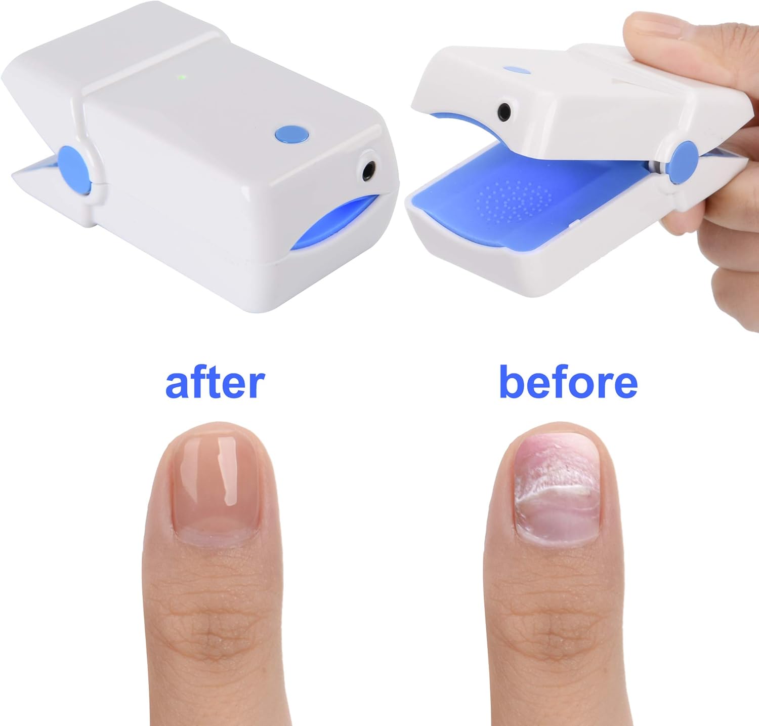 Tippytoe Nail Fungus Remover Laser Device, Safer, Quicker Results, Painless Therapy Treatment For Toes And Fingernails, No Side Effects, Portable, Treats Nail Discoloration, For Home Use: Health & Personal Care
