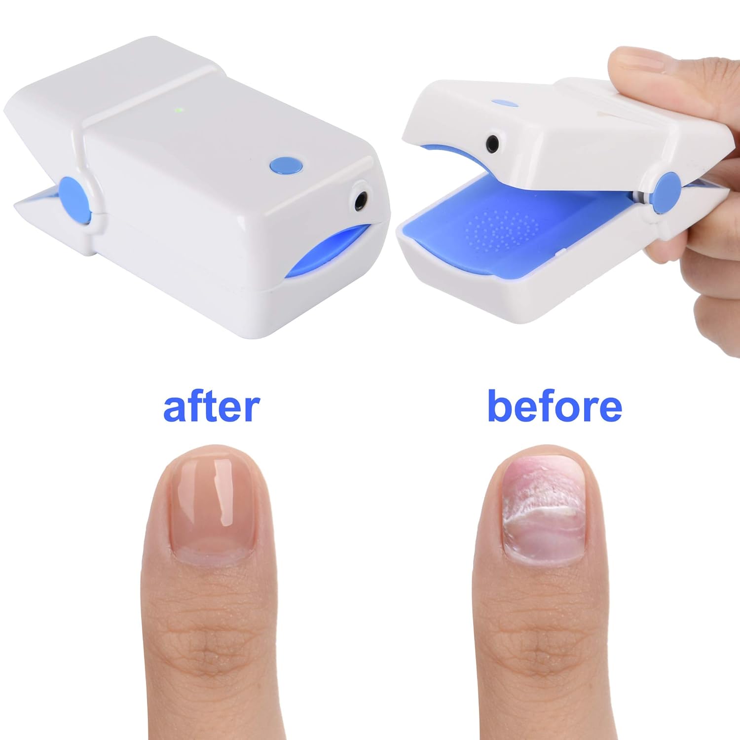 Magnetoe Portable Nail Fungus Remover Laser Device, Safer, Quicker Results, Painless Therapy Treatment, No Side Effects, Treats Discoloration, Solution-Repair and Strengthen Toenails and Fingernails : Beauty
