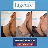 TagCure Skin Tag Removal Kit - Includes 10 Tag Bands, 10 Swabs & 10 Plasters view 2