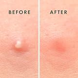 Rael Pimple Patches Miracle Invisible Spot Cover 96 Patches 2 Sizes view 6