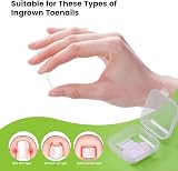 BEZOX Ingrown Toenail Corrector Set 40 Pcs Pain-Free Toenail Strips view 4
