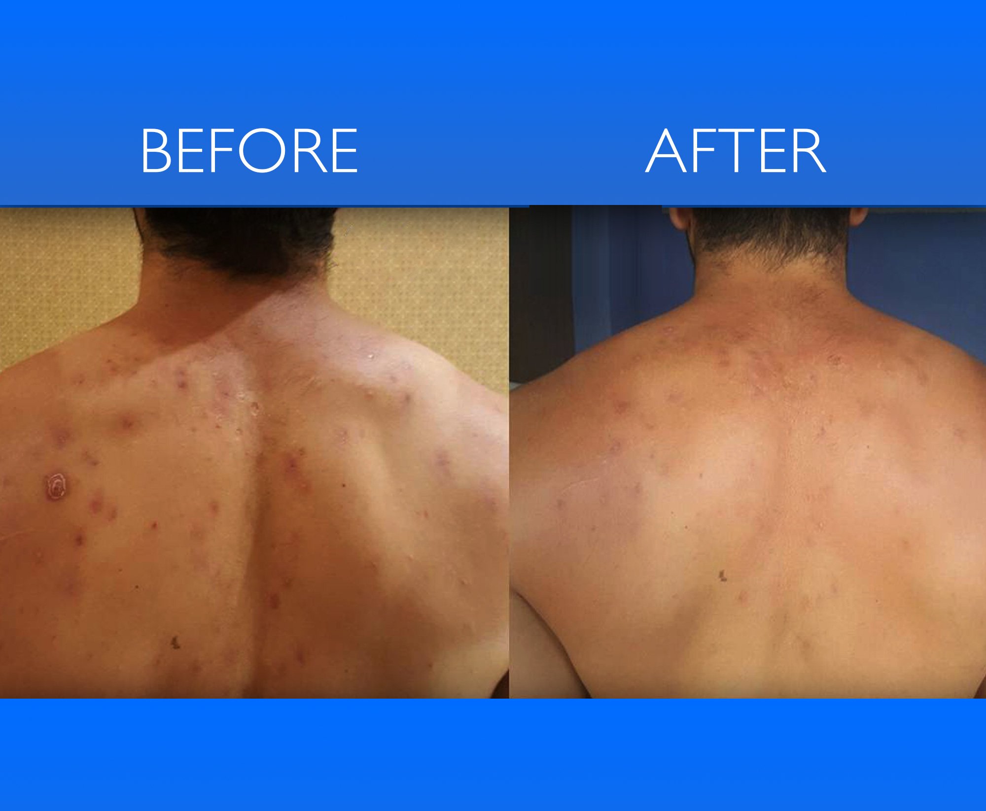 Hair Conditioner for Blemish Free Skin by Clear 2