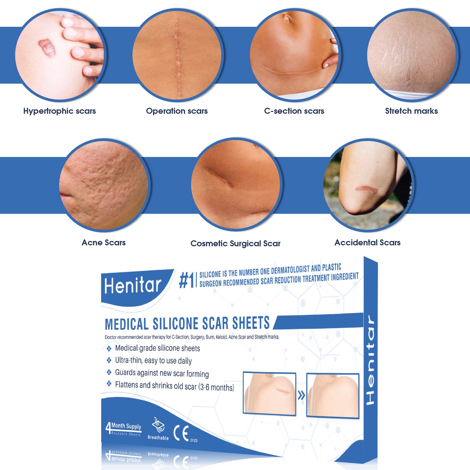 HENITAR Medical Silicone Scar Sheets, Soften and Flattens Scars, Ideal for Stretch Marks, Works on Old & New Scars, C-Section, Surgery, Burn, Injuries, Acne, and more scars, 5.7"×1.57” : Beauty
