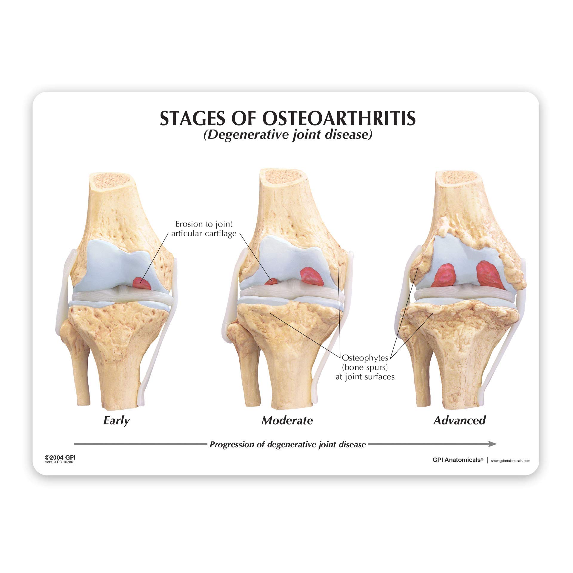Mua Knee Set 3/4 size Osteoarthritis Set of 4 Anatomical Model w ...