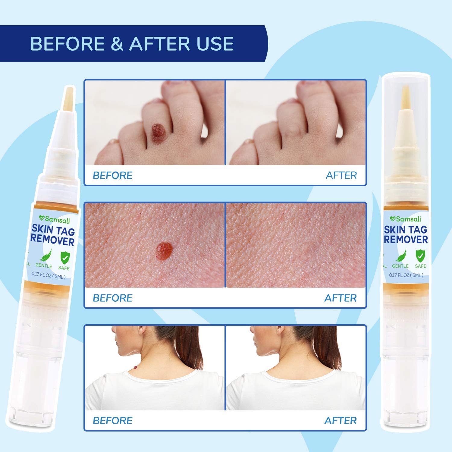 Samsali Skin Tag Remover, Skin Tag Removal For All Kind Of Skin, Best Skin Tag Remover: Health & Personal Care