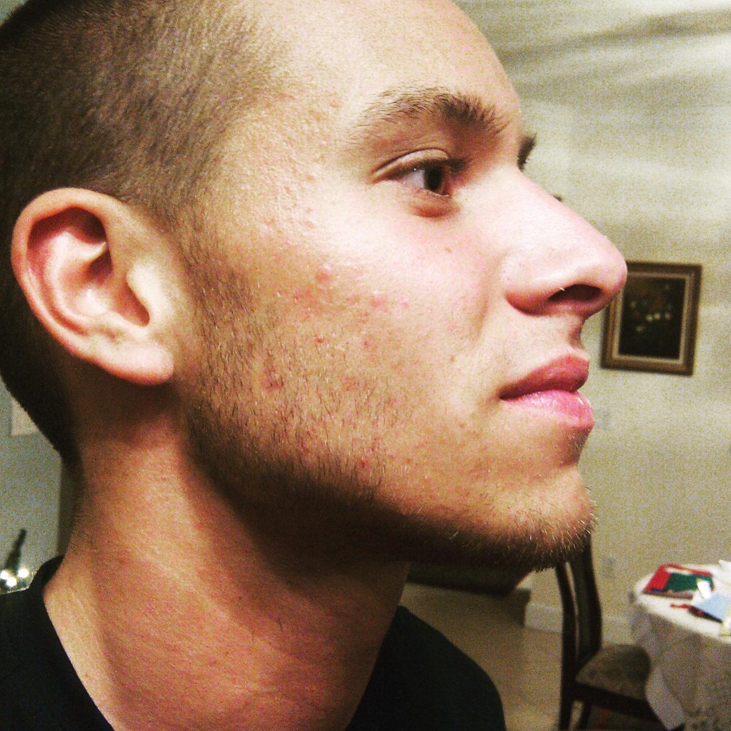 Light Matte Moisturizer - Probiotic help prevent Acne, Rosacea, and Eczema. The Probiotic and Peptide Maintains the glow, softness, and tightness of clear skin.