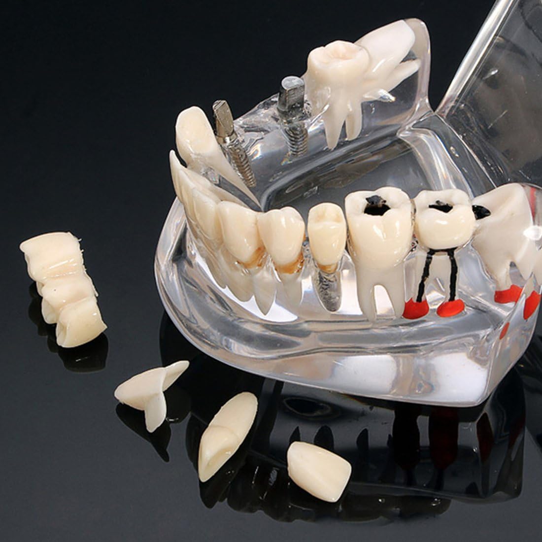 Dental Implant Disease Teeth Model with Restoration Bridge Malocclusion Orthodontic Model for Medical Science Dental
