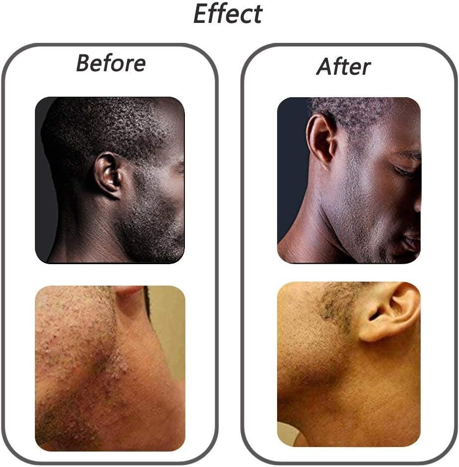 Exfoliating Brush To Treat And Prevent Razor Bumps And Ingrown