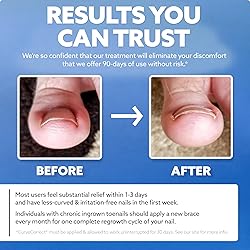 CurveCorrect® Ingrown Toenail Treatment Kit