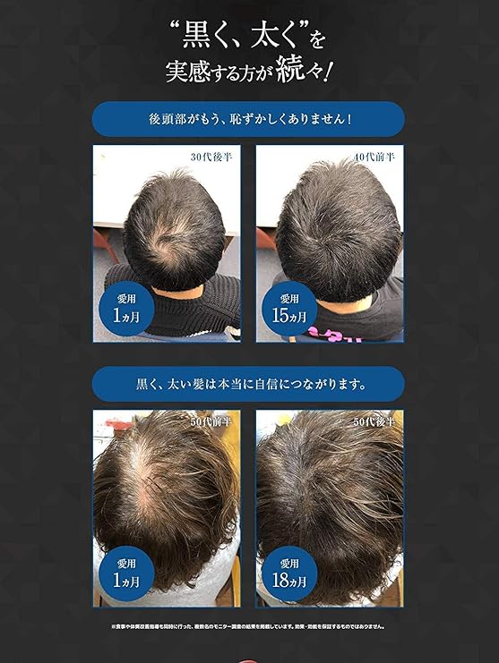 Groxil グロキシル ヘアトニック 1ml 医薬部外品 薄毛と白髪wケア 育毛剤 男性用 女性用 白髪ケア 育毛 トニック 養毛 薄毛 抜け毛 白髪 Groxil グロキシル ヘアトニック 通販 Amazon
