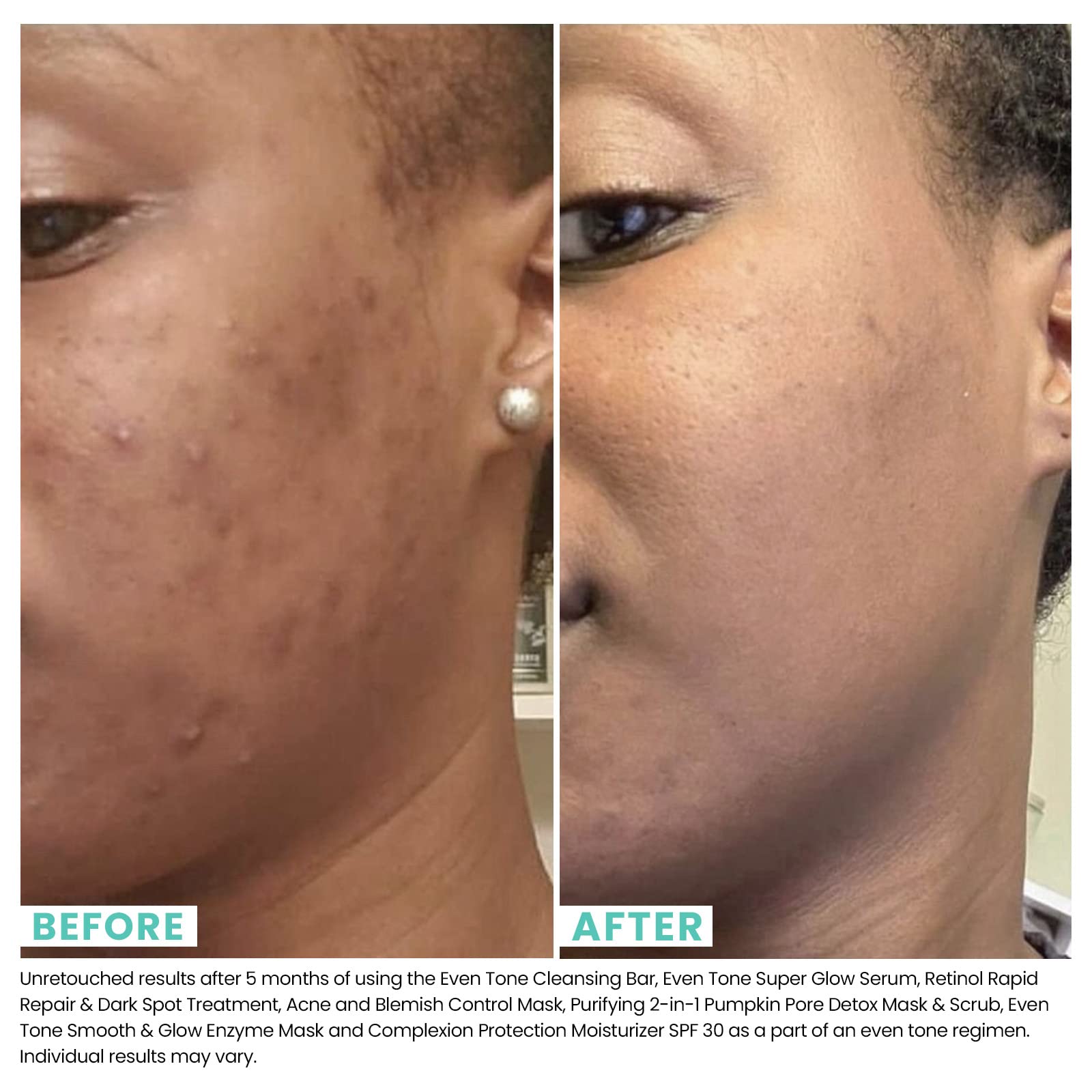 Urban Rx Acne Mua Urban Skin Rx Acne and Blemish Control Mask | Dual-action Mask ...