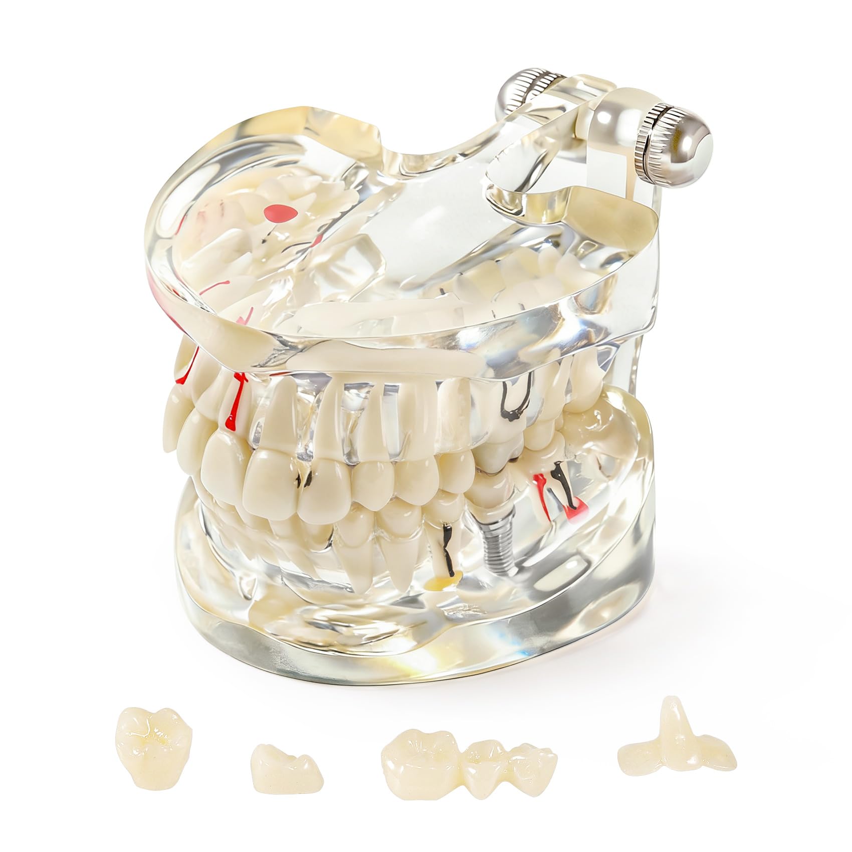 Annhua Disease Teeth Model Transparent Dental Model with Removable Teeth, Resin Pathological Teeth Model with Adjustable Angle, Teaching Teeth Model for Dental Students, Dentist, and Kids