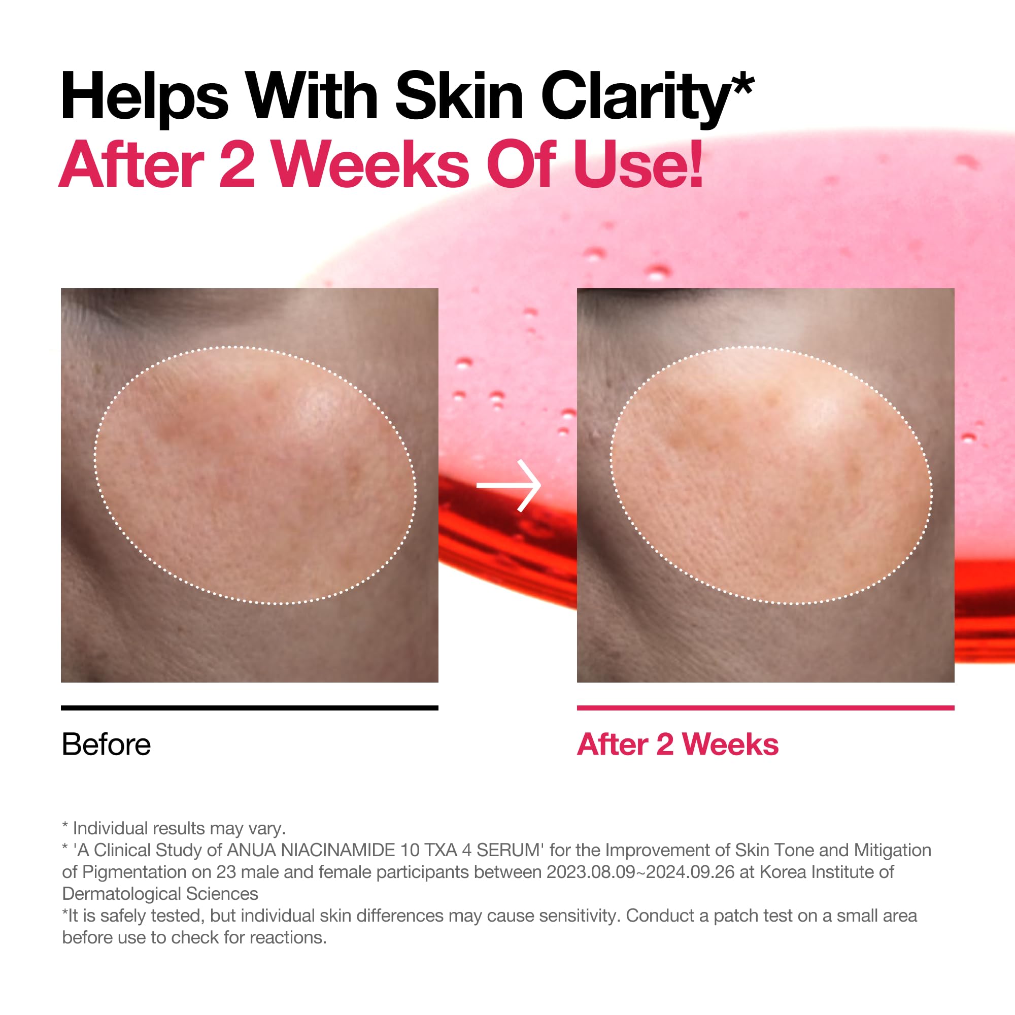 ANUA Niacinamide 10 + TXA 4 Serum, Hyaluronic Acid, Tranexamic acid, Facial Serum For GlassSkin, Cardi B’s Pick, Glow Back Serum, Dark Spot Care, Postnatal Skincare, Korean Skincare (30ml/1.01 fl.oz)