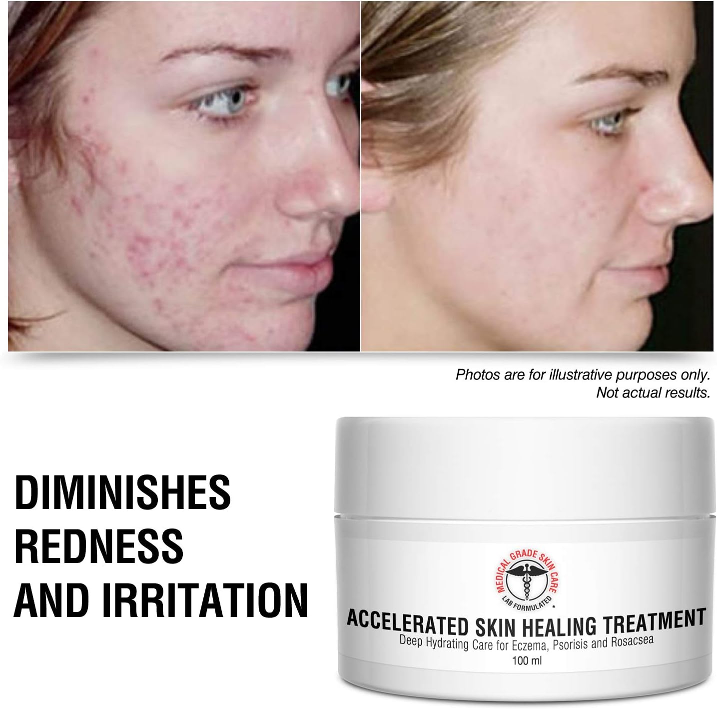 Eczema, Rosacea, Dermatitis, and Psoriasis Cream - Medical Grade Accelerated Skin Healing Treatment, Deep Hydrating Skin Lotion, Instant Skin Relief: Health & Personal Care
