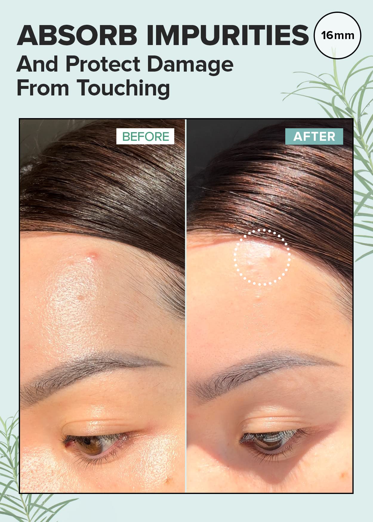 I DEW CARE Hydrocolloid Acne Pimple Patch - Timeout Blemish Dark Spot | Korean zit Patches for face and skin, Facial Stickers, Pus absorbing with Tea Tree Leaf Oil, 32 Count