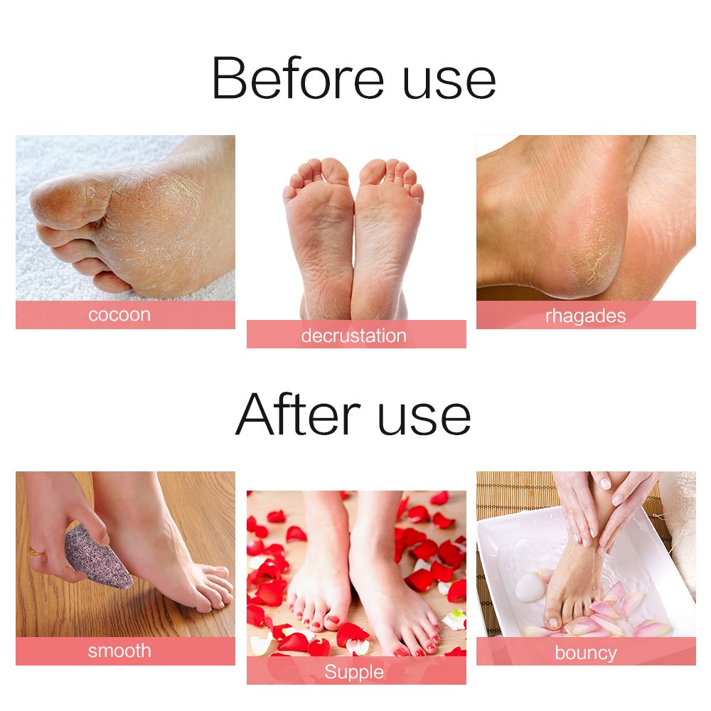 2 Pack Drops Shape Pumice Stone, Horsky Earth Lava SPA Soft Healthy Foot Callus Remover for Dry Hard Dead Skin Cracked Heel in Feet and Hands Skin Exfoliator Scrubber