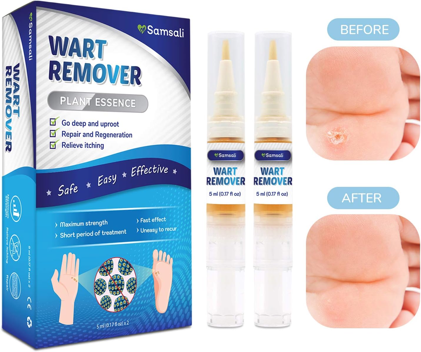 Samsali Wart Remover, Maximum Strength, Easy and Painless Wart Remover,  Removing all Kinds of Common Warts, Best Wart Remover for Removing Warts: Health & Personal Care