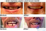 Instant Smile Multishade Temporary Tooth Repair Kit - 30 False Teeth view 3