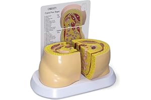 GPI Anatomicals - Obesity Model, Replica of The Hip Area Depicting Effects of Obesity for Human Anatomy and Physiology Education, Anatomy Model for Doctor's Offices, Medical Learning Resources