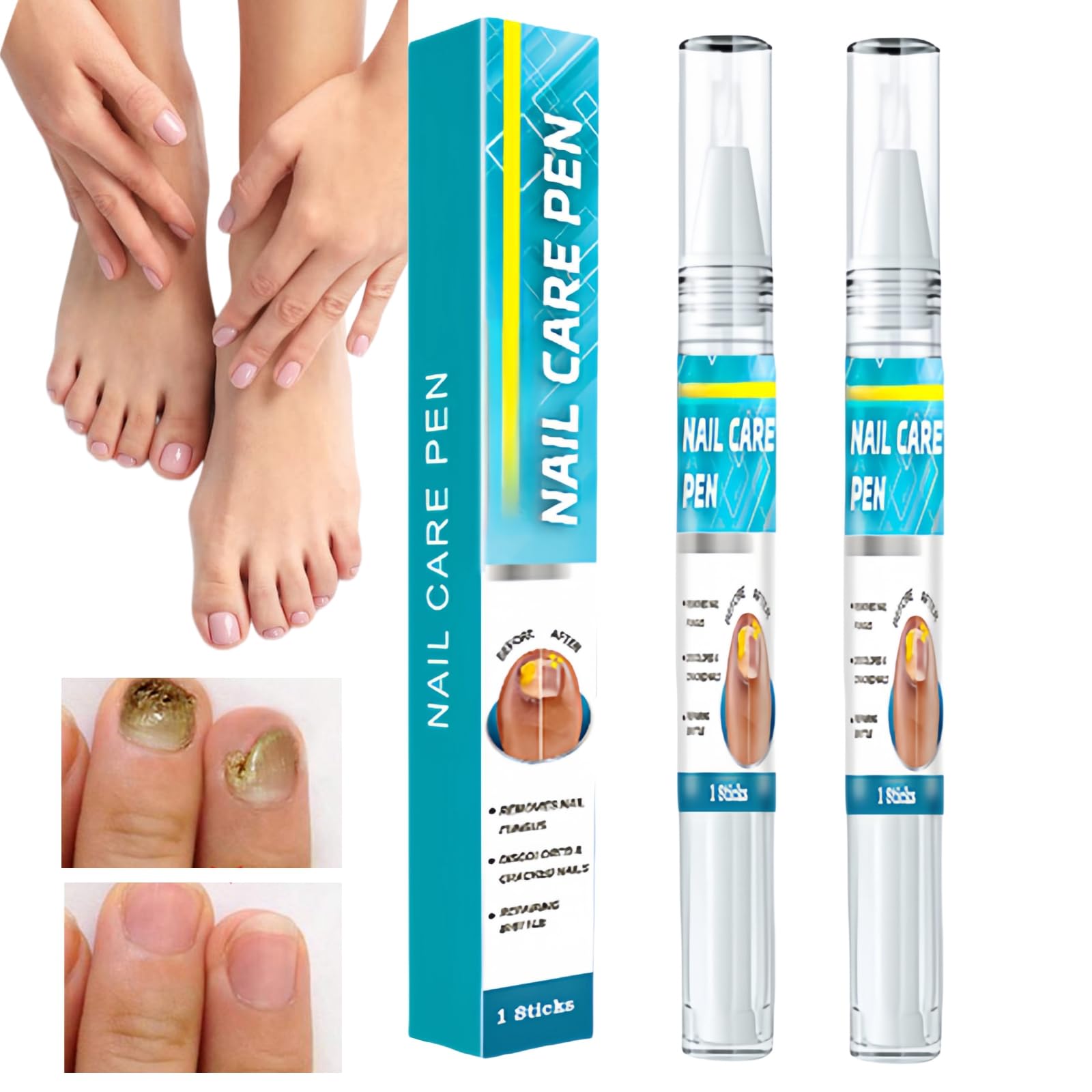 2PCS Nail Revive Pen,Nail Care Pen for Fungus & Ingrown & Thick Nail,Fungal Nail Treatment,Nail Repair Essence for Under & Around Nail,Nail Fungus Treatment for Toenail,Anti Fungal Skin Cream