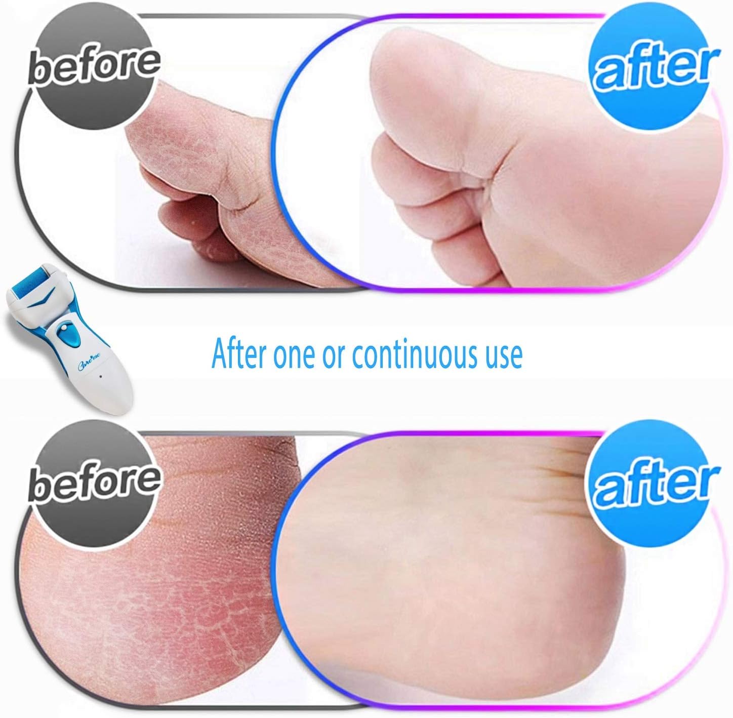 Care me Powerful Electric Foot Callus Remover Rechargeable-Top Rated Electronic Foot File Removes Dry, Dead, Hard, Cracked Skin & Calluses- Best Foot Care Pedicure Tool for Soft Smooth Feet: Health & Personal Care