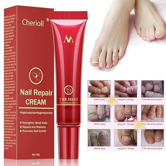 Nail fungus, nail treatment, cream, nail polish against nail fungus