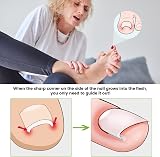 BEZOX Ingrown Toenail Corrector Set 40 Pcs Pain-Free Toenail Strips view 2