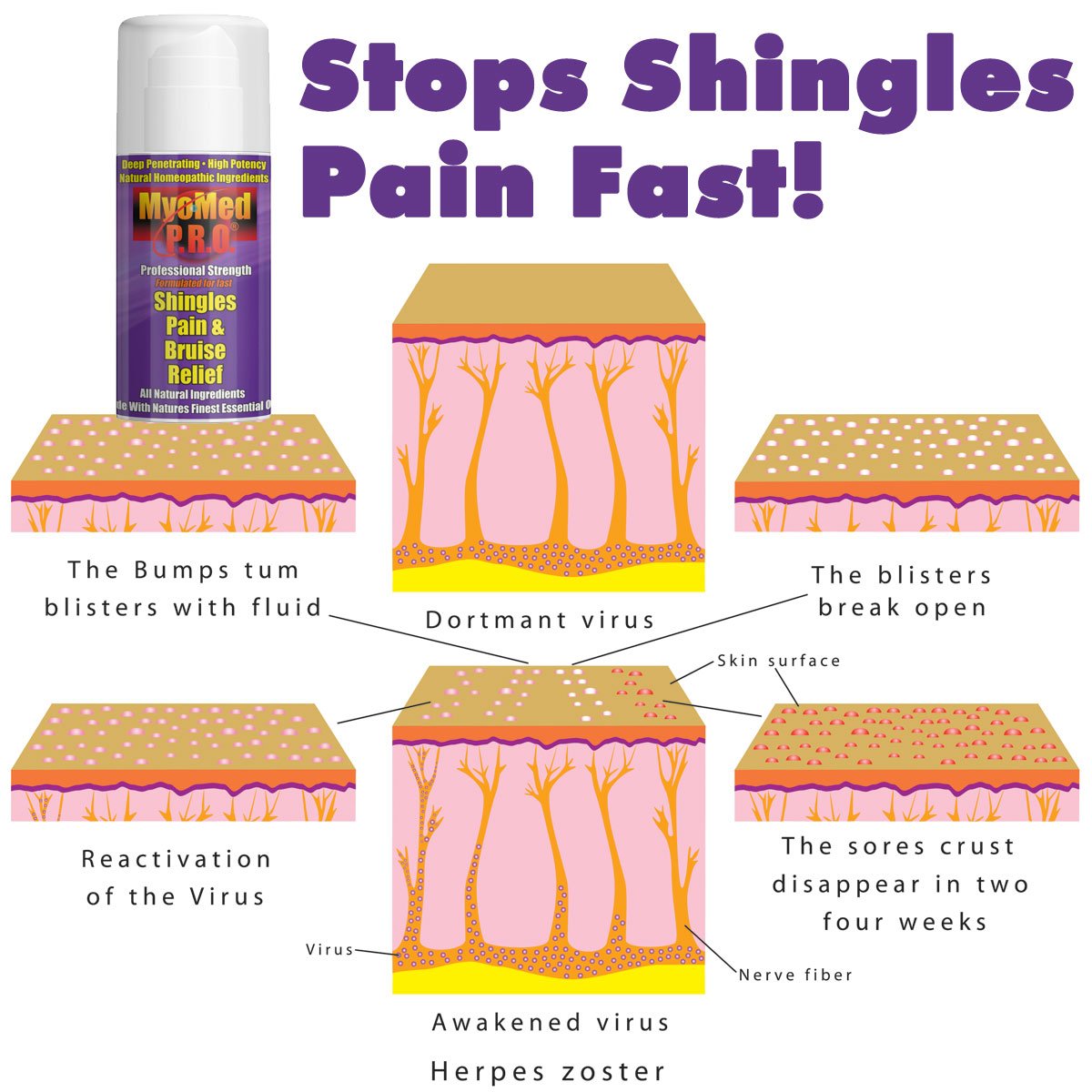 Best Shingles Treatment Cream For Pain Relief Essential Oil Topical Formula Provides Maximum Recovery Stops Burning Itching Nerve Pain Heals -