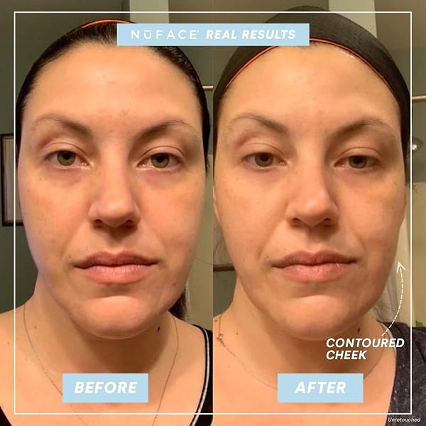 NUFACE TRINITY COMPLETE – FACIAL TONING KIT