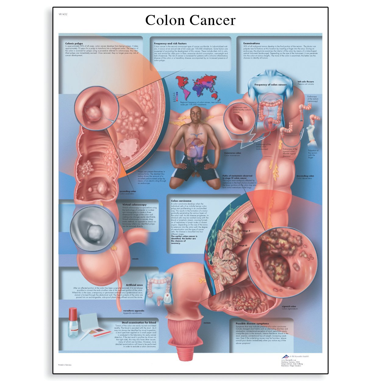 3B Scientific VR1432UU Human Anatomy Colon Cancer Chart, Paper Version