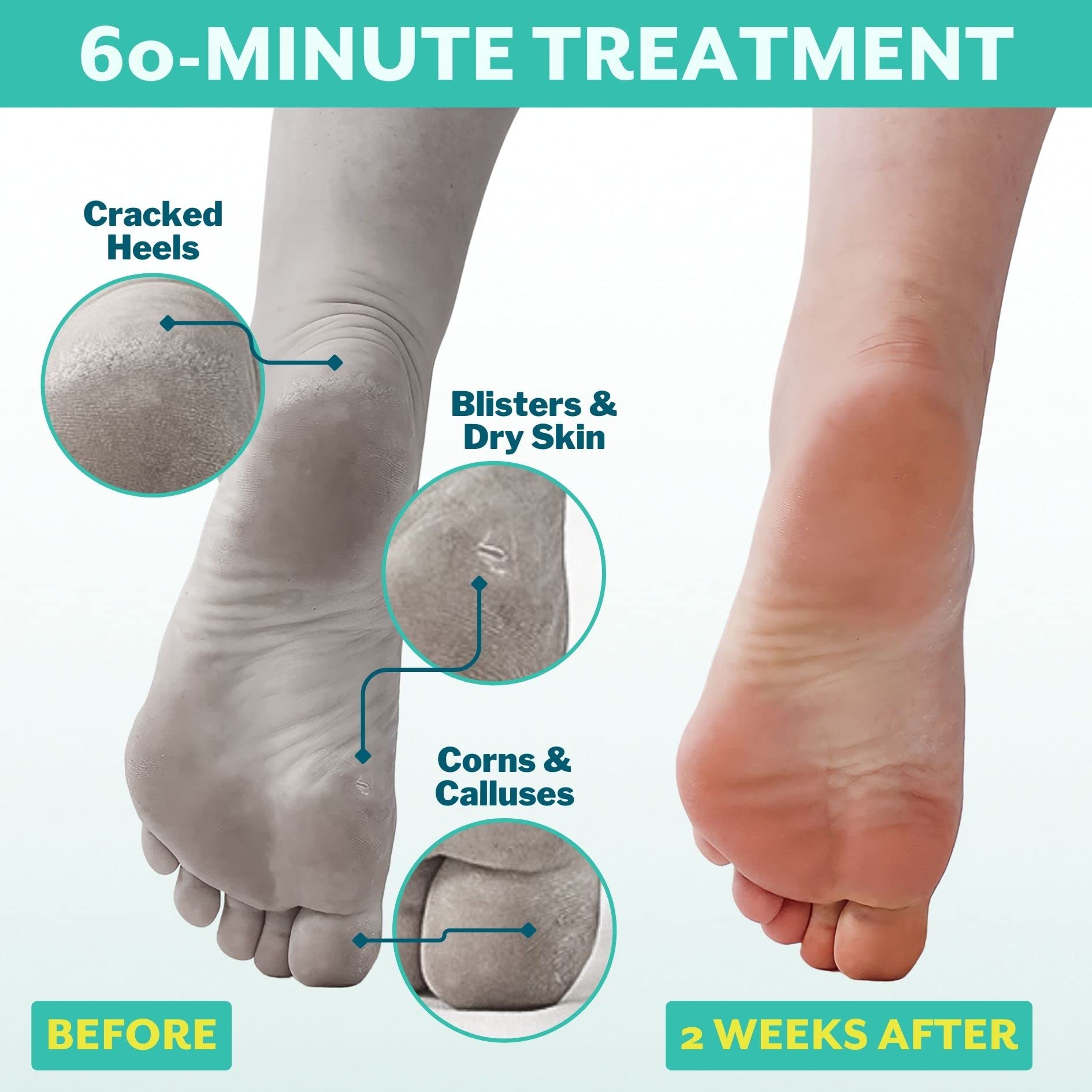 Patchology PoshPeel Pedi Cure - Foot Peel Mask Soak Treatment, Feet Peeling Mask, Pedicure Booties with Deep Exfoliation for Baby-soft Skin, Pedicure Supplies for Foot Care, 1 Pair