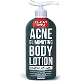 TreeActiv Acne Eliminating Body Lotion 8 fl oz | Clears Body, Back, Butt and Shoulder Acne | Anti-Acne Moisturizer | Prevents Future Breakouts | Cucumber Mint Scent