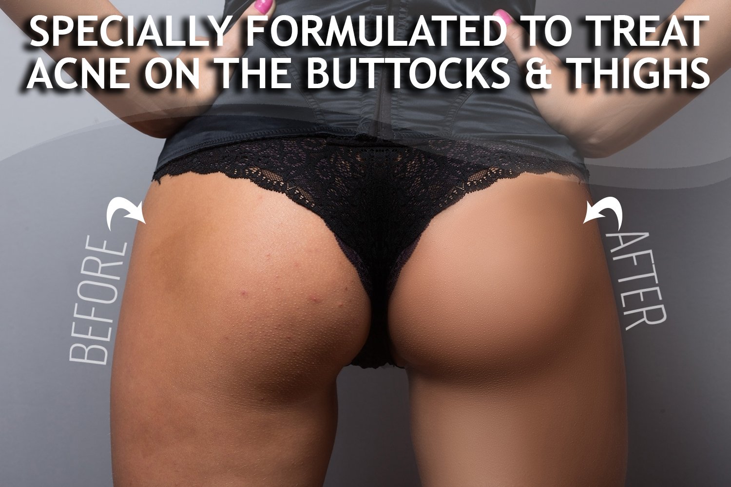 Anti Acne Buttocks Thigh Treatment Clears Away Acne Pimples