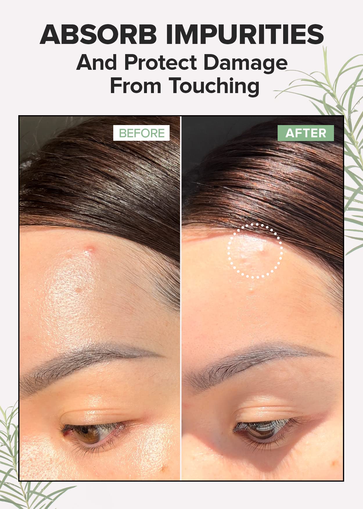 I DEW CARE Hydrocolloid Acne Pimple Patch Trio - Meet Your Patch Set | Korean zit blemish dark spot patches for face and skin, 96 Count assorted, Three Sizes, Tea Tree Oil