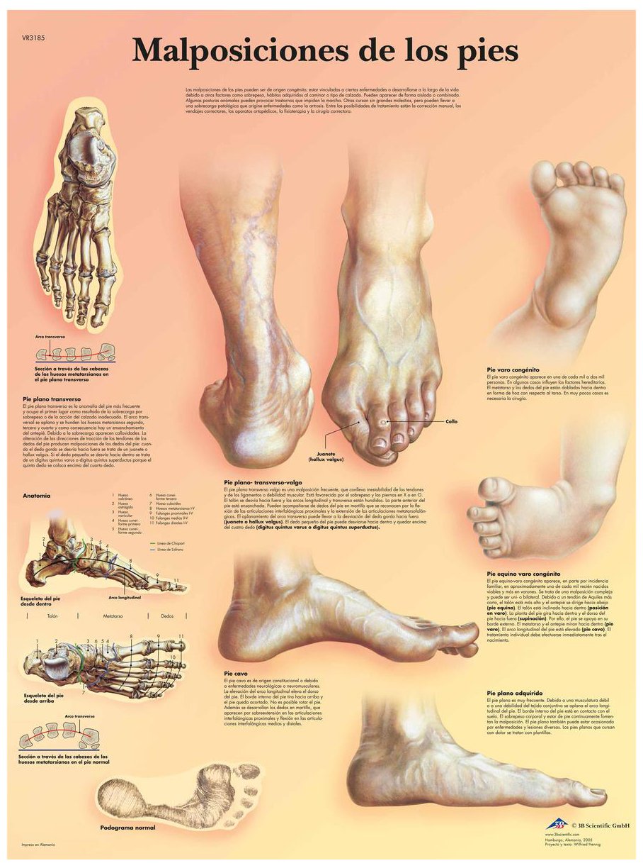 3B Scientific VR3185UU Anatomical Chart "Malposiciones de Los Pies", Paper Version