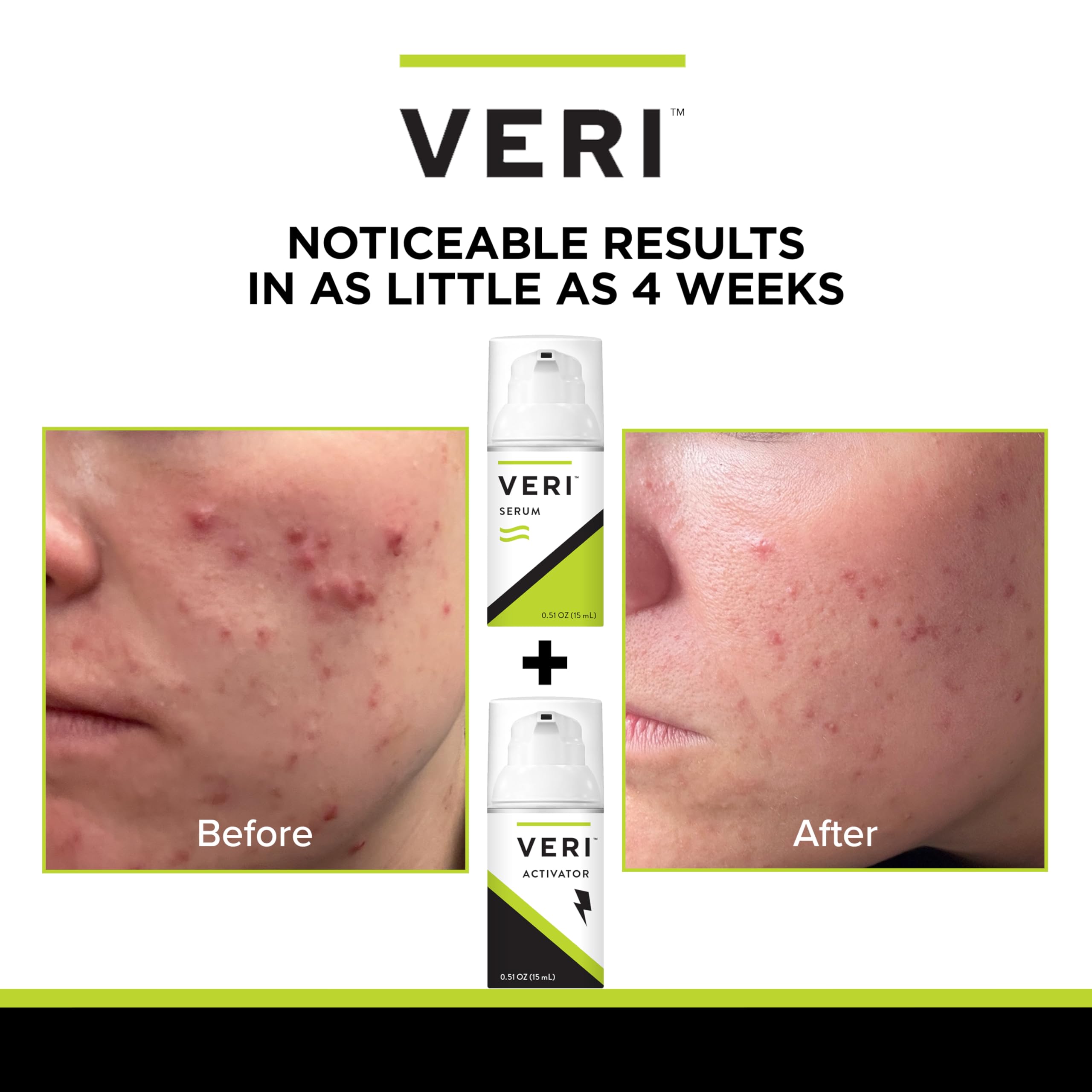 VERI Nitric Oxide + Salicylic Acid Clear Skin System (Peroxide-Free)- For Acne Prone Skin, Unclogs Pores, Clarifies Blemishes, Reduces Inflammation, Prevent Future Breakouts, 30 mL / 1 oz