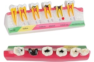 Healthible Periodontal Disease Model, Typodont Periodontal Disease, Dental Teeth Model for Dental Tooth Anatomy Study, Doctor-Patient and Oral Care Education