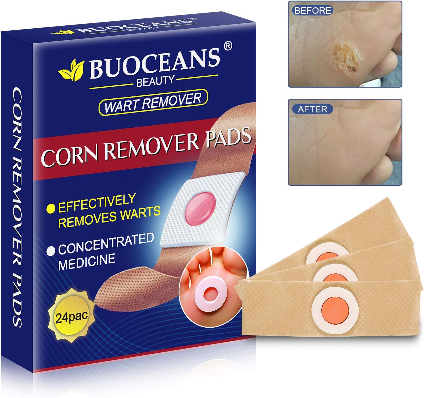 freezing corns on feet