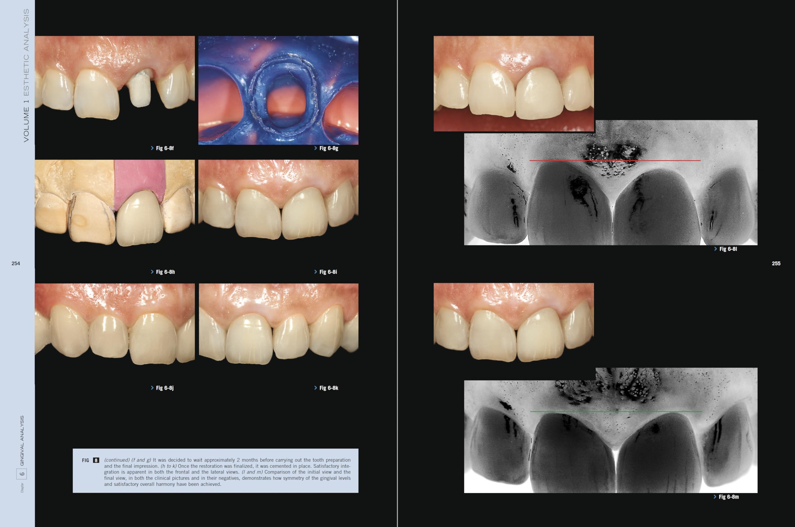 Esthetic Rehabilitation In Fixed Prosthodontics: Esthetic Analysis: A Systematic Approach To Prosthetic Treatment Esthetic Rehabilitation In Fixed Prosthodontics: Esthetic Analysis: A Systematic Approach To Prosthetic Treatment Hardcover