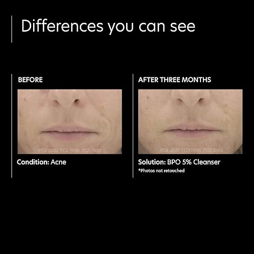 bpo 5 percent cleanser