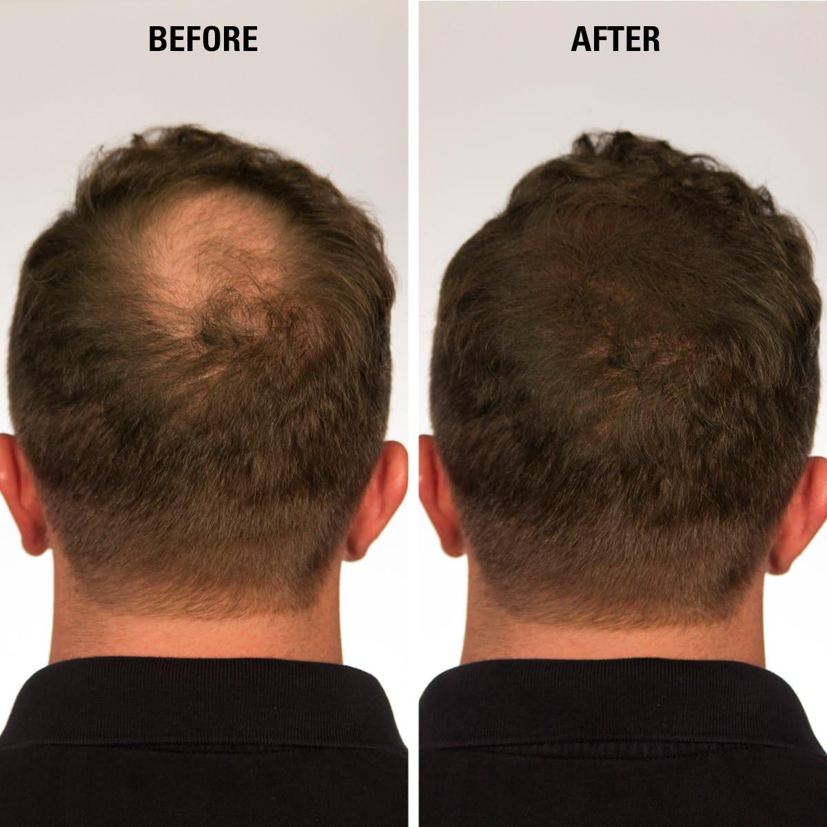 ECLIPSE Hair Fibres, Medium Brown, Natural Look Hair Building Fibres for Thinning Hair for Women & Men, Conceals Visible Hair Loss, 15g - Image 5