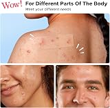 LitBear Large Pimple Patches Hydrocolloid 156 Patches 5 Sizes view 4