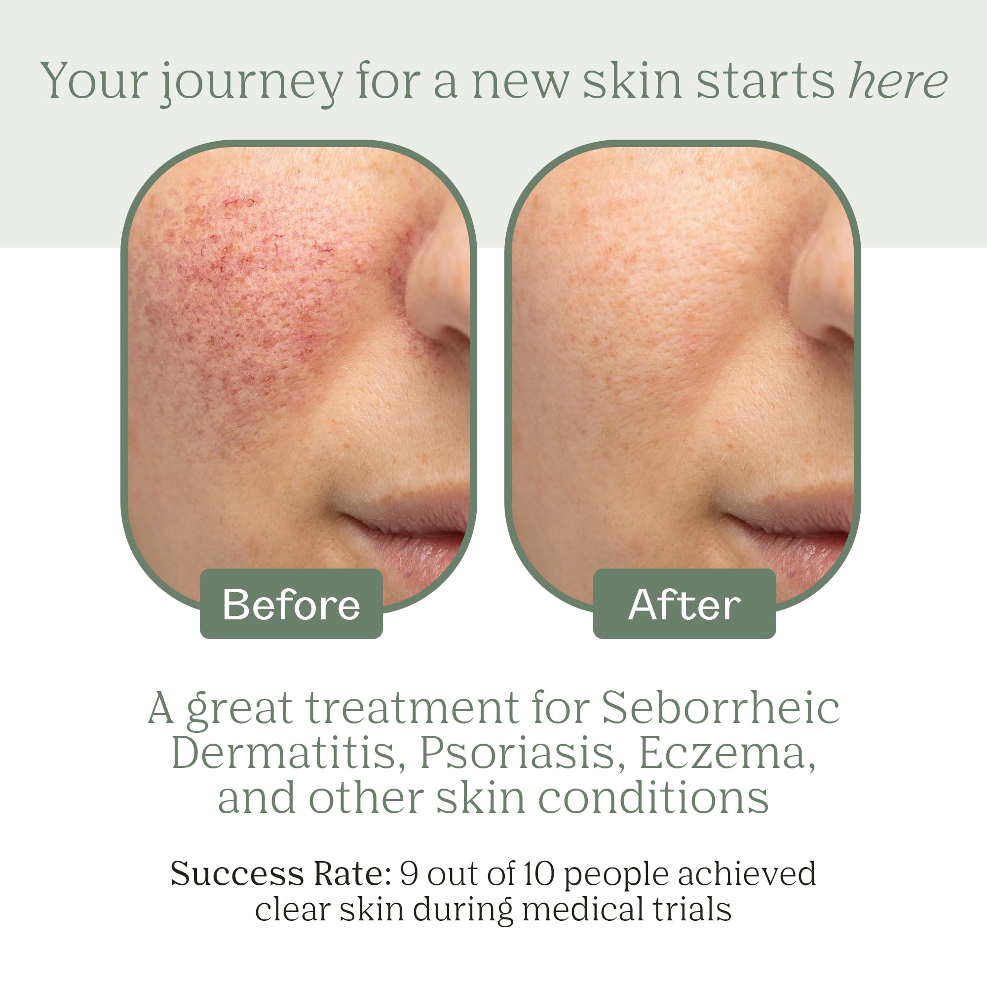 Dermabon Seborrheic Dermatitis Cream, Eczema & Psoriasis Treatment - Calendula Extract, Salicylic Acid, Bee Wax -Soothes, Hydrates & Balances Skin Tone - Moisturizing & Skin Relaxing Relief