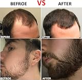 LacyMC Beard Roller 0.5mm Titanium Needles for Hair Growth Stimulation 540 view 6